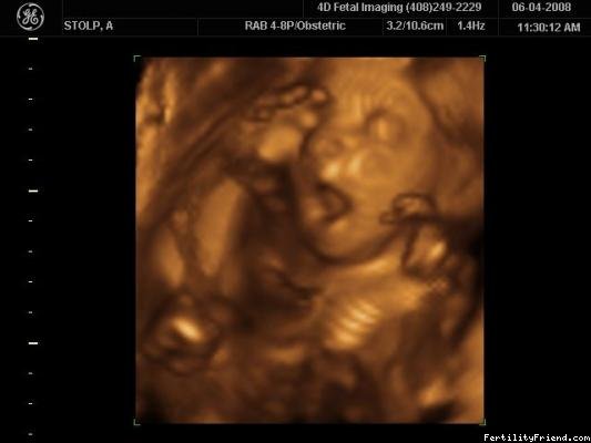 3D ultrazvuk 26. - 30. týden