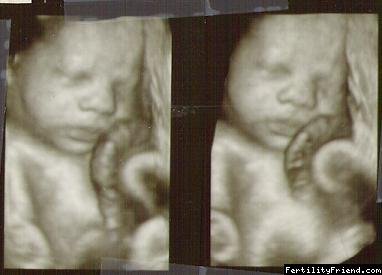 3D ultrazvuk 31. - 40. týden